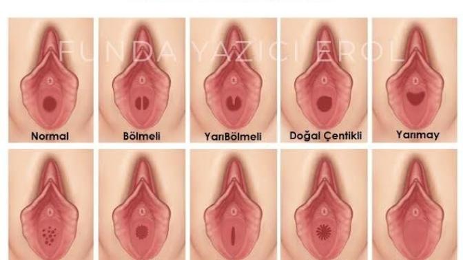 Ilişkide kızlık zarı çeşitlerinin bir öne var mıdır?