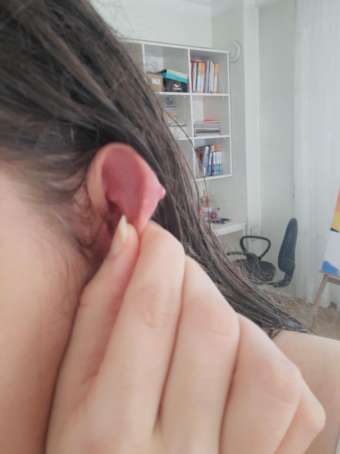 Kulağımdaki piercing yeri çok şişti?