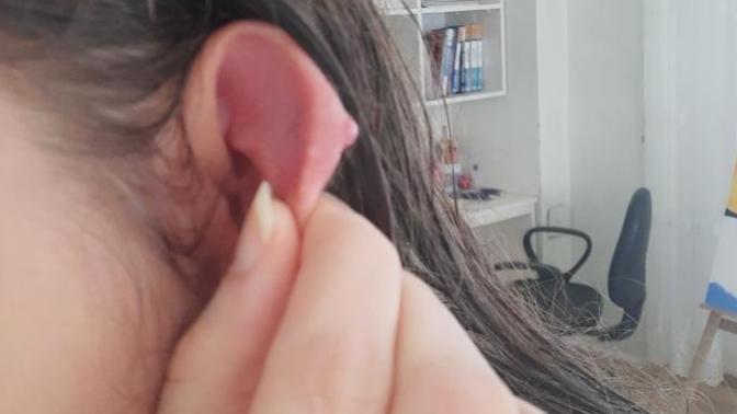 Kulağımdaki piercing yeri çok şişti?