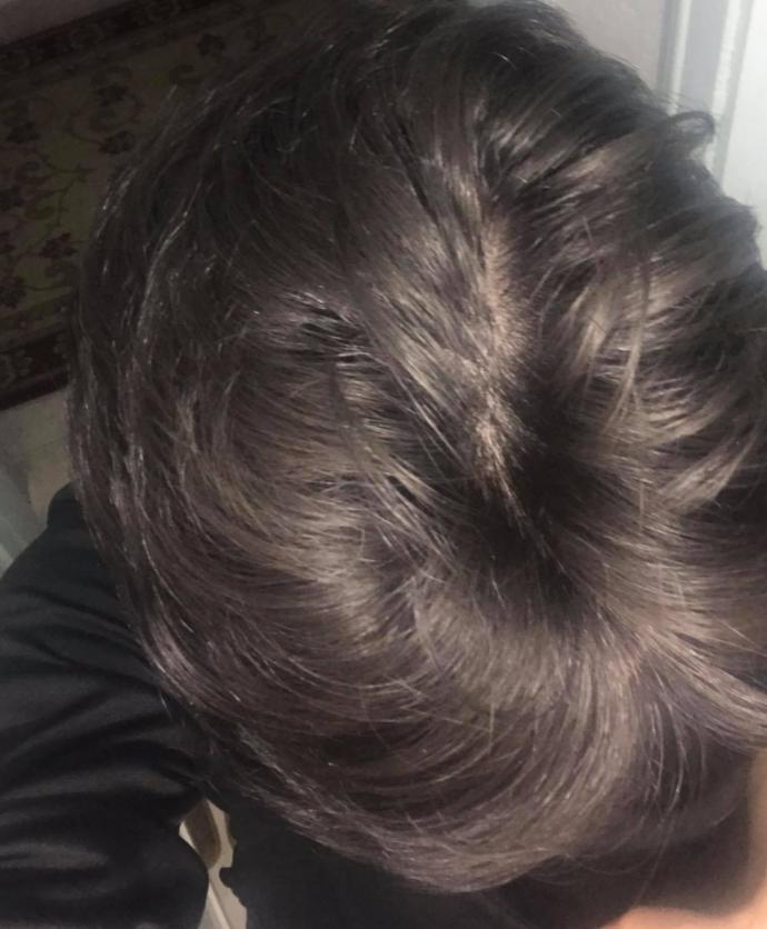 Saçım açılmış mı, dökülüyor mu yoksa?