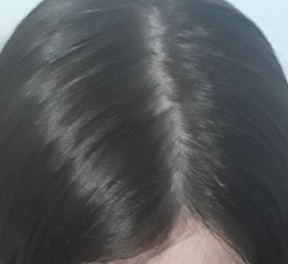 Saçımın ortası çok mu kel?
