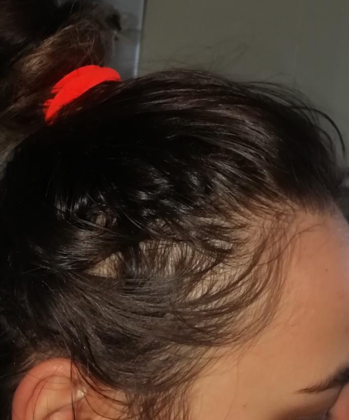 Bu erkek tipi saç dökülmesi mi Resimli?
