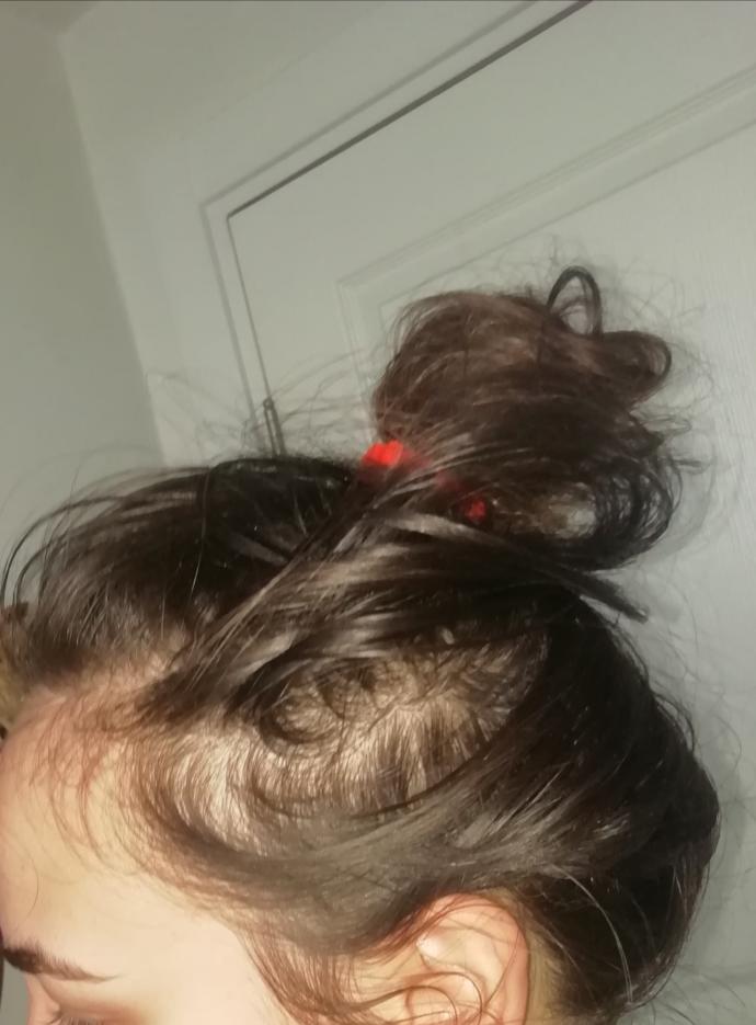 Bu erkek tipi saç dökülmesi mi Resimli?