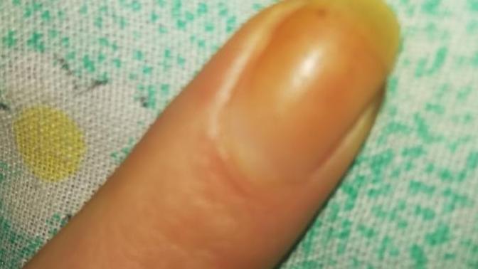 Tırnak sararması neden olur işaret parmağında?