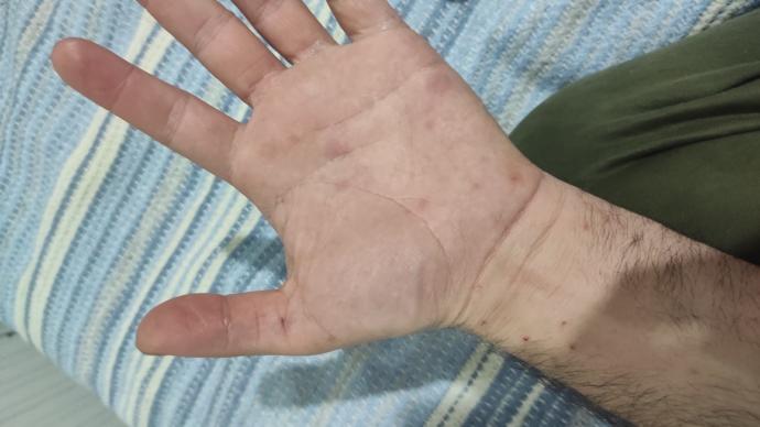 Bitmeyen vücut kaşıntısı ve sivilce benzeri şeyler neden cikar?