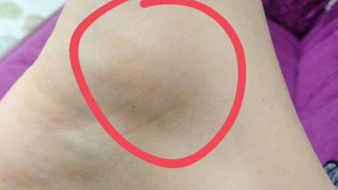 Şu ayak bileğinin iç kemiğinin altındaki kemik çok ağrıyor üzerine zor basıyorum arkadaşlar niye sizce?(fotoğraflı)?
