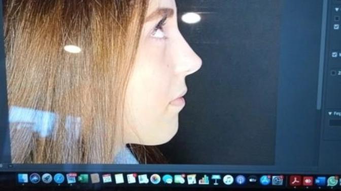 Eveet sonunda burun estetiği ameliyatı oldum?