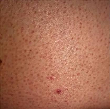 Popomda ve bacaklarimda belirgin kıl koklerim ve sivilce lekeleri var nasıl geçer?