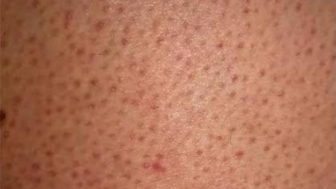 Popomda ve bacaklarimda belirgin kıl koklerim ve sivilce lekeleri var nasıl geçer?