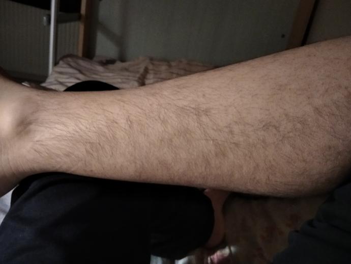Bu bacak kılları nasıl tamamen yok edilir?
