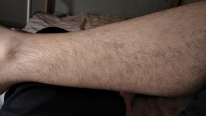 Bu bacak kılları nasıl tamamen yok edilir?