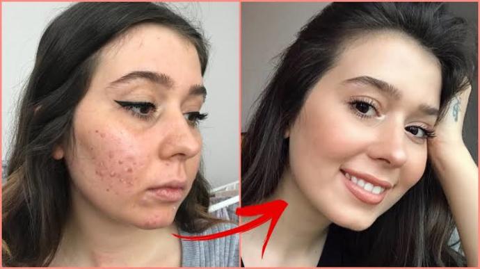 Roaccutane sivilce kusması