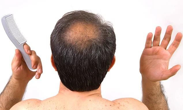 Babam 30 yaşında kel kalmış. Benim kel kalma ihtimalim yüzde kaç?
