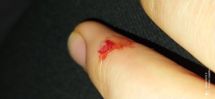 Köpek ısırdı bir şey olur mu?
