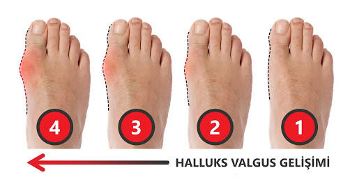 Hallux valgus (ayak) ameliyatı olan var mı?