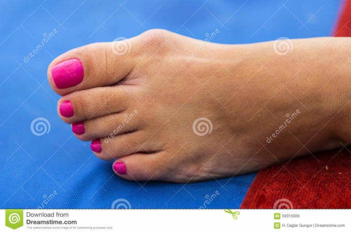 Hallux valgus (ayak) ameliyatı olan var mı?