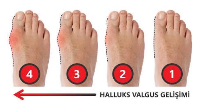 Hallux valgus (ayak) ameliyatı olan var mı?
