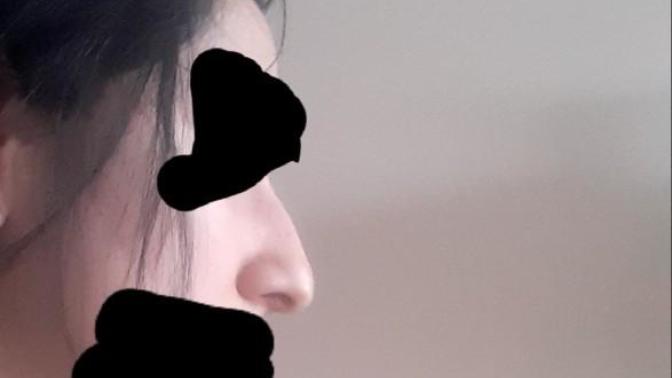 Burnum çok kötü, bir sevgilim var sanaldan tanıştık. Beni burnum yüzünden bırakır mı?