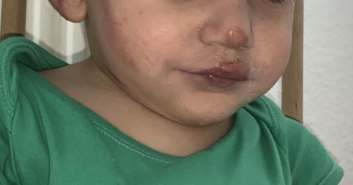 Ikinci paylasimim bu yanik iz kalirmi?