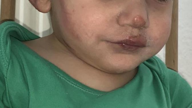 Ikinci paylasimim bu yanik iz kalirmi?