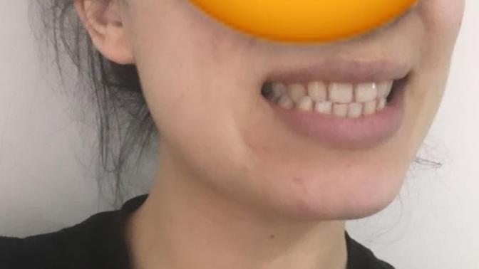 Dişlerim çok kötü değil mi 😕?