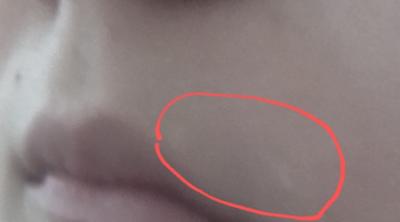 Arkadaslar Yuzumde Beyaz Beyaz Lekeler Olusuyor Neden Cok Korkuyorum Vitiligo Mu Yoksa Fotografli Kizlarsoruyor