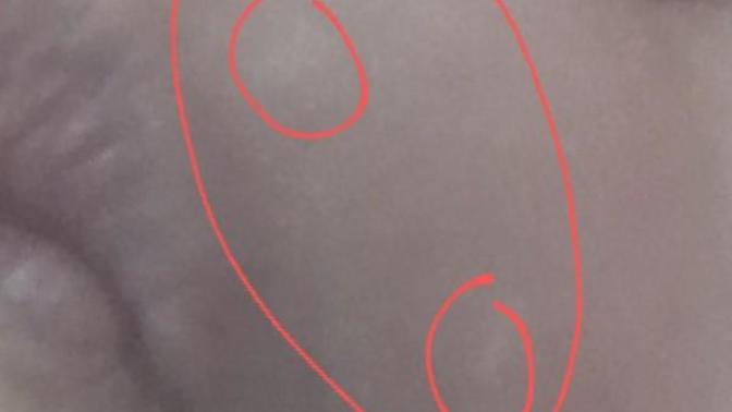 Arkadaşlar yüzümde beyaz beyaz lekeler oluşuyor neden? Çok korkuyorum vitiligo mu yoksa? Fotoğraflı?