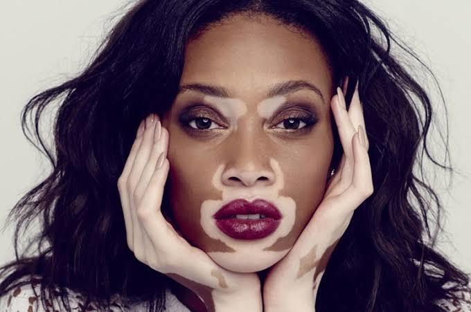 Vitiligo hastası bir kadının görüntüsü sizi rahatsız eder mi?