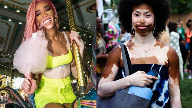 Vitiligo hastası bir kadının görüntüsü sizi rahatsız eder mi?