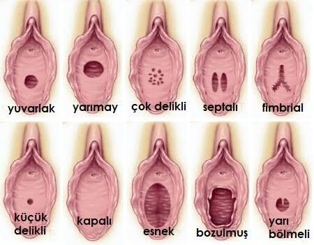 Çentikli kızlık zarı yırtık mı demektir?