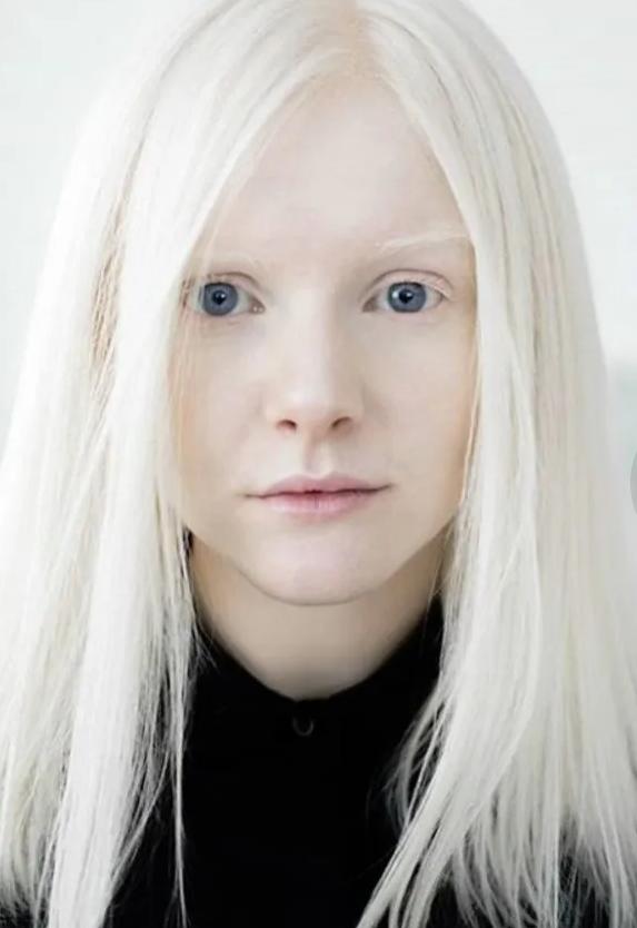 Albino hastaları hakkında ne düşünüyorsunuz?
