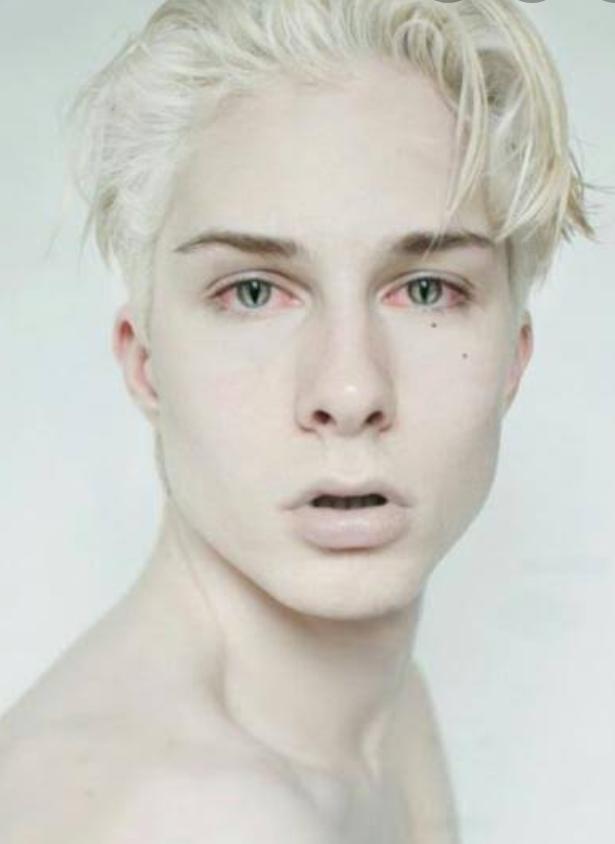 Albino hastaları hakkında ne düşünüyorsunuz?
