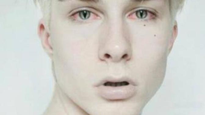 Albino hastaları hakkında ne düşünüyorsunuz?