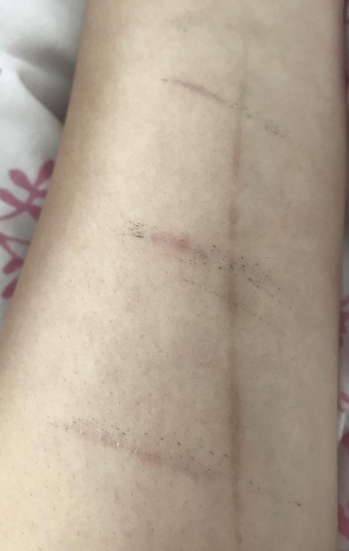 Bunlar iz kalır mı kavladı hala kırmızı sizce iz kalır mı geçer mi?