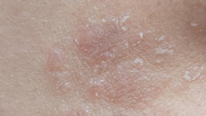 Çenemde oluşan şey nedir? Kaşınıyor ve acıyor? Yayılmaya başladı. Yardım edin😭?