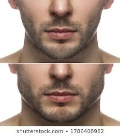 Her erkek jawline dolgusu yaptırmalı mı?