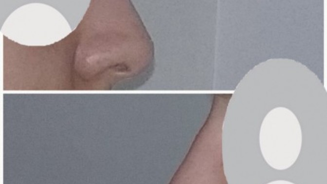 Sizce burnum güzel mi? Böyle bir burun için estetik olmak mantıklı mı?