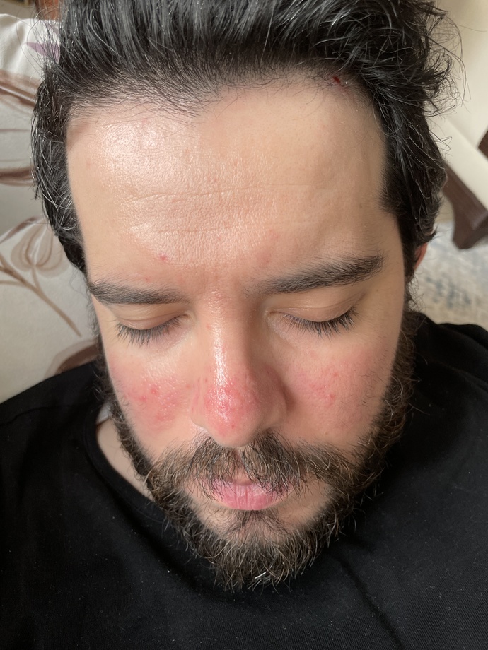 Black Peel yaptırdım. Sizce nasıl olmuş?