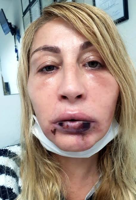 Antalyada bir kadın estetik için geçirdiği 4 operasyon sonrasında alt dudağını kaybetti. Siz de güzel görünmek için yaptırır mısınız?