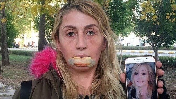 Antalya'da bir kadın estetik için geçirdiği 4 operasyon sonrasında alt dudağını kaybetti. Siz de güzel görünmek için yaptırır mısınız?