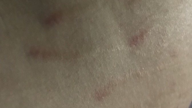 Vücutta böyle şeyler varsa nasıl geçer?