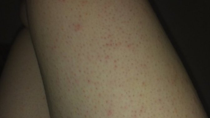 Bu kızarıklıklar nasıl geçer?