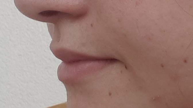 Yüzümdeki benler çok mu kötü duruyor?