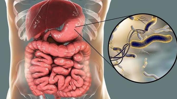 Dünya her 3 kişiden 1'inde bulunan ve mide kanserine yol açan sinsi düşman helicobacter pylori 'nin semptomlarını biliyor musun ?