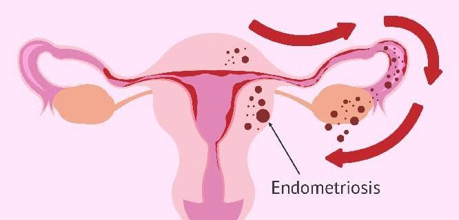 Kadınlarda regl olduktan sonra yani üreme çağına girdikten sonra görülen endometriyozis (Çikolata kisti) neden oluşur?