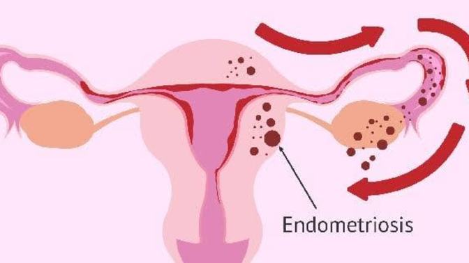 Kadınlarda regl olduktan sonra yani üreme çağına girdikten sonra görülen endometriyozis (Çikolata kisti) neden oluşur?