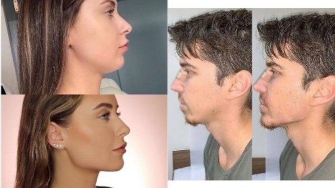 Jawline dolguya bakış açınız nedir? Jawline yaptırarak güzel olunur mu?