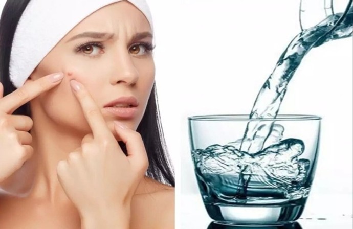 Bol su içersem sivilce izlerim azalır mı?
