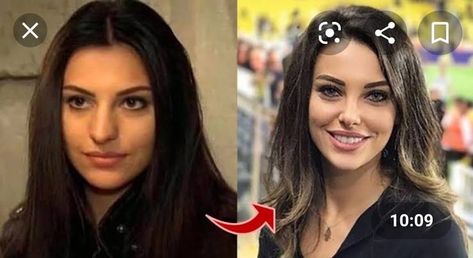 Estetikle güzelleşen kadınların çocukları güzel olur mu?