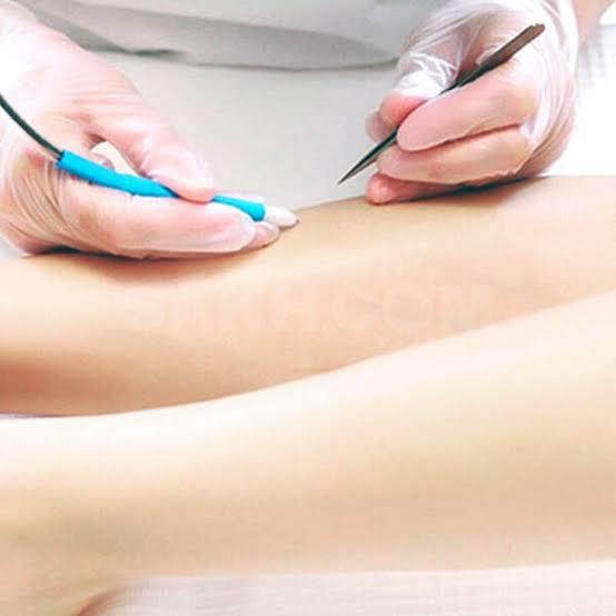 İğneli epilasyon yaptırmayı düşünür müsünüz? Tüylerinizden kurtulmak için bu acıya değer mi?